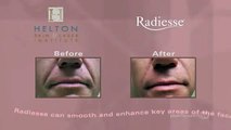 PWTV - Radiesse Facial Rejuvenation