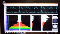Electrocardiogram using Arduino and ECG/EKG shield