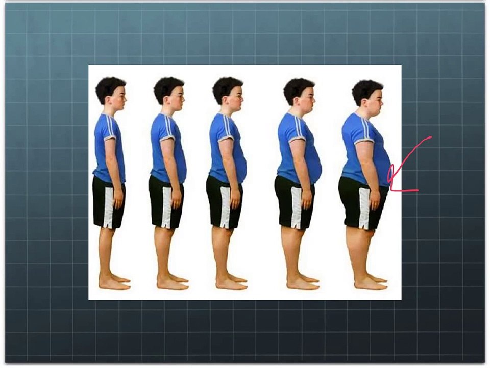 Prader-Willi Syndrome