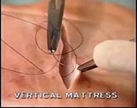 vertical mattress suturing surgical operation