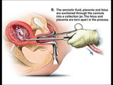 Suction & Curettage Abortion Illustrated / Vacuum Aspiration Abortions / Video