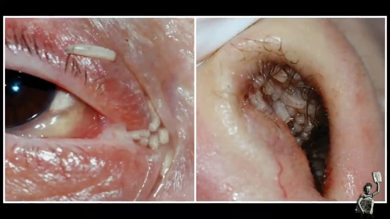 Maggots removed from woman’s nose and eye after fly lays eggs in intensive care