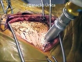 Craniotomia Tumor Cerebral Microcirurgia