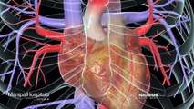 CABG | Coronary Artery Bypass Surgery | Heart Disease Treatment | Heart Hospital | Manipal Hospitals