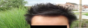 Hairline and temple transplantation on diffuse thinning hairloss patient