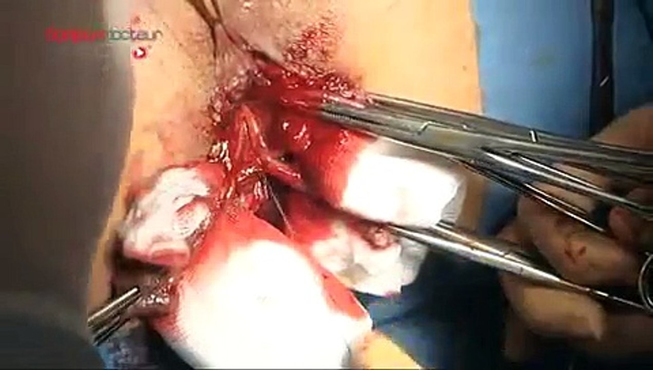 Hemorroides et Chirurgie