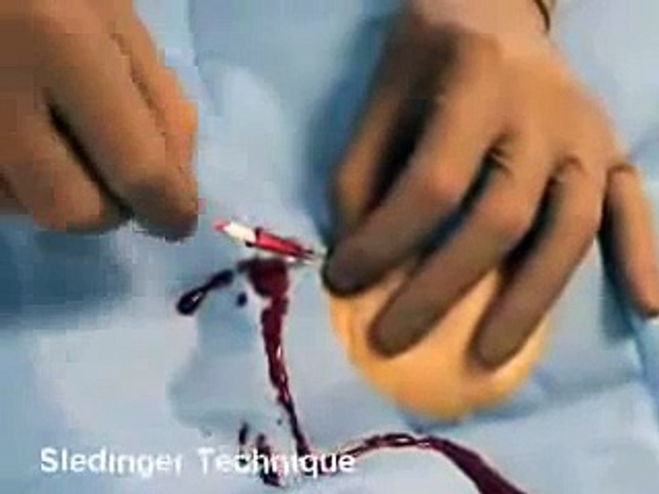 Arterial Line Placement