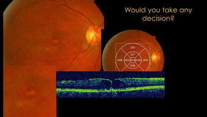 Foveal Retinitis Reactivation, Secondary to Ocular Toxoplasmosis Eleonora Beatriz Lavaque