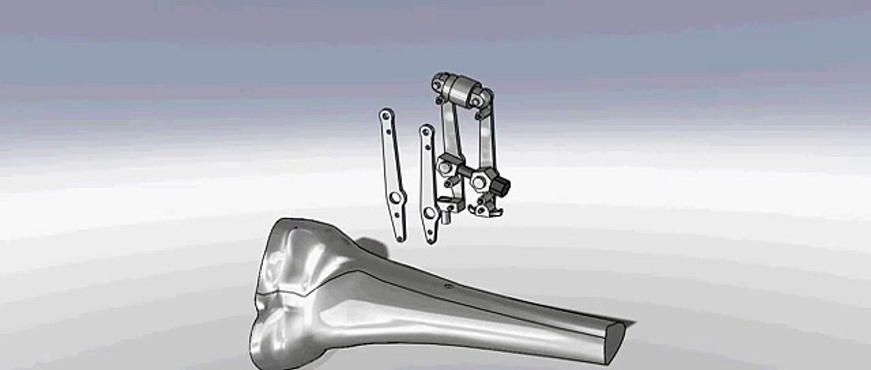 Exploded view of Synthes Articulated Tension Device video Dailymotion