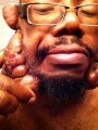 Man opens Keloid Scars on his face...Disgusting