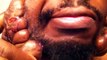 Man opens Keloid Scars on his face...Disgusting