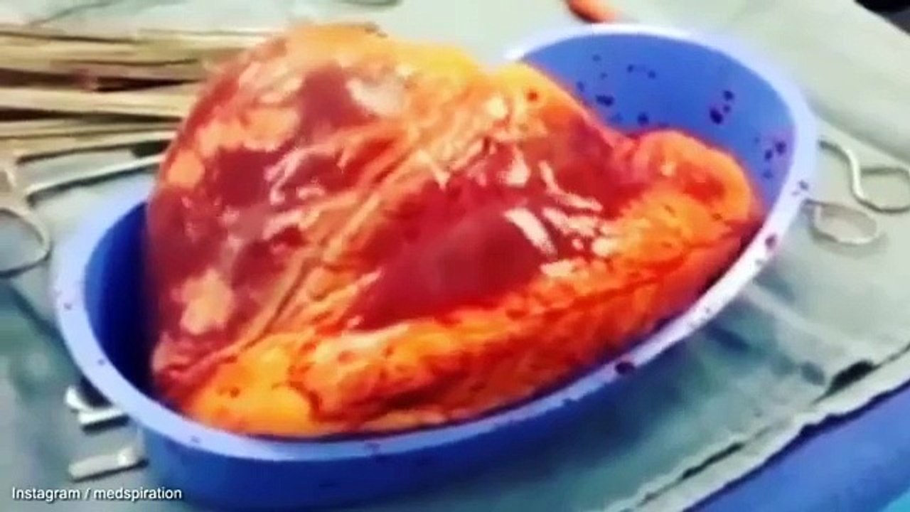 Graphic video shows effects of cocaine on explanted heart