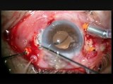 Secondary Intrascleral IOL Implantation According to Schariot Technique Cesare Forlini