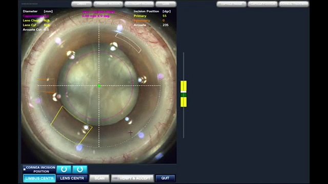 Femtosecond laser surgery in a complex cataract case Dr. Mahipal Sachdev