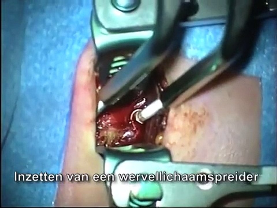 operatie nekhernia.mov