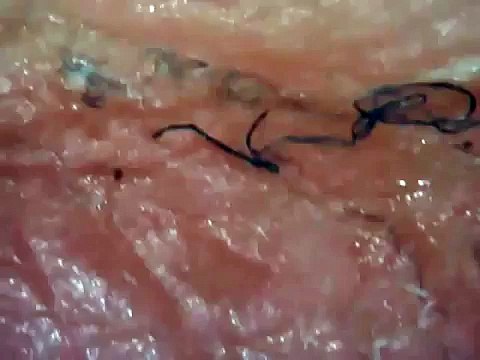 БОЛЕЗНЬ МОРГЕЛЛОНОВ КРУПНЫМ ПЛАНОМ; ГМО ПРОДУКТЫ