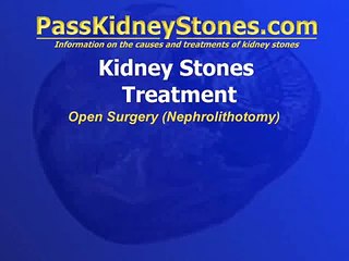 Download Video: Open Surgery For Kidney Stones