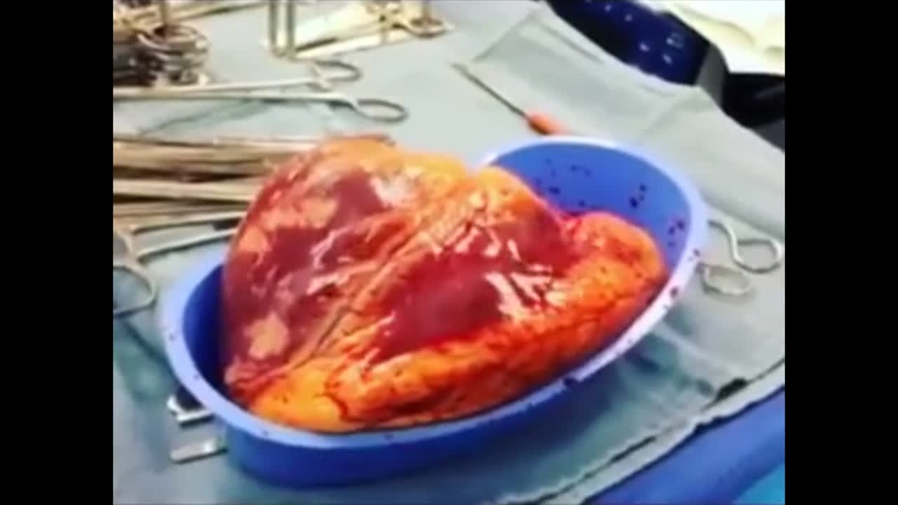 Nos Estados Unidos, coração humano com cocaína bate 25 minutos fora do corpo!