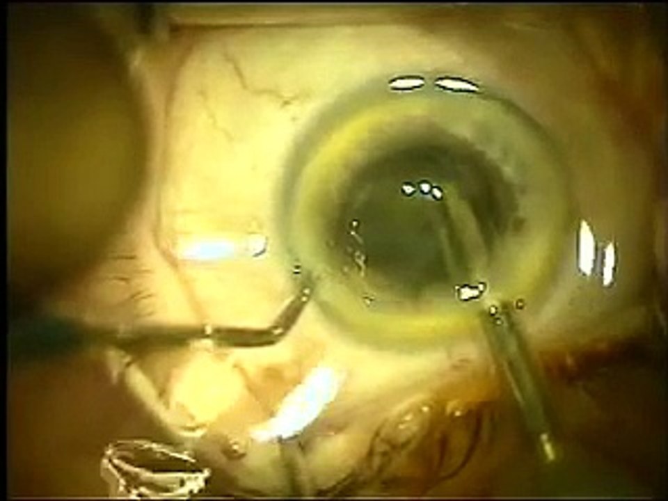 Cataract surgery