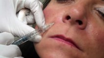 Dr. Choe injects Juvederm to smile lines (Nasolabial folds)