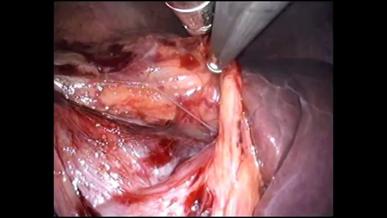 Single Incision Laparoscopic Nephrectomy