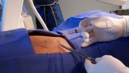 Splanchnic Nerve Block