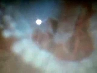 argon laser photocoagulation for retinal tear