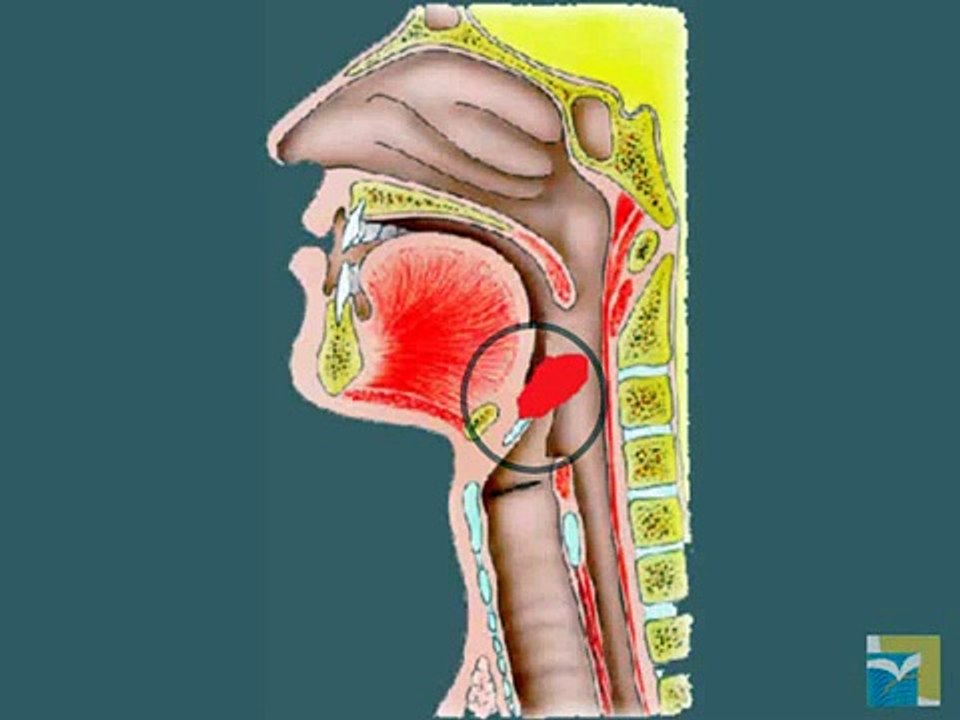 Epiglottite