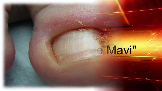 Uñas encarnadas de los dedos del pie o uñero - Que hacer - Como curar
