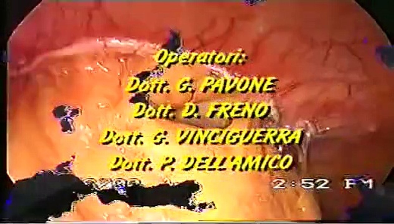 Video intervento chirurgico laparocele