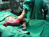 Giving Birth: Cesarean Section