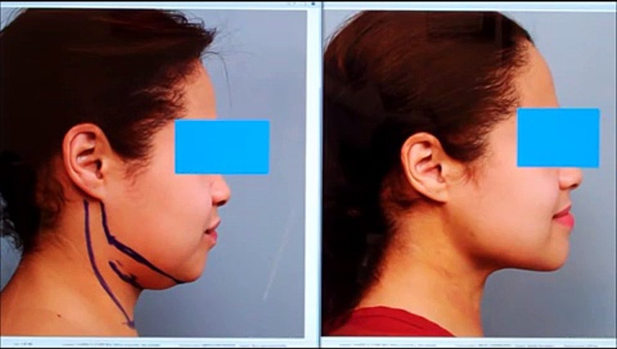 Chin SmartLipo, Neck Liposuction Case Study | Dr. Sterry