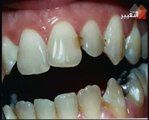 خيط الأسنان لتنظيف الفراغات الضيقة