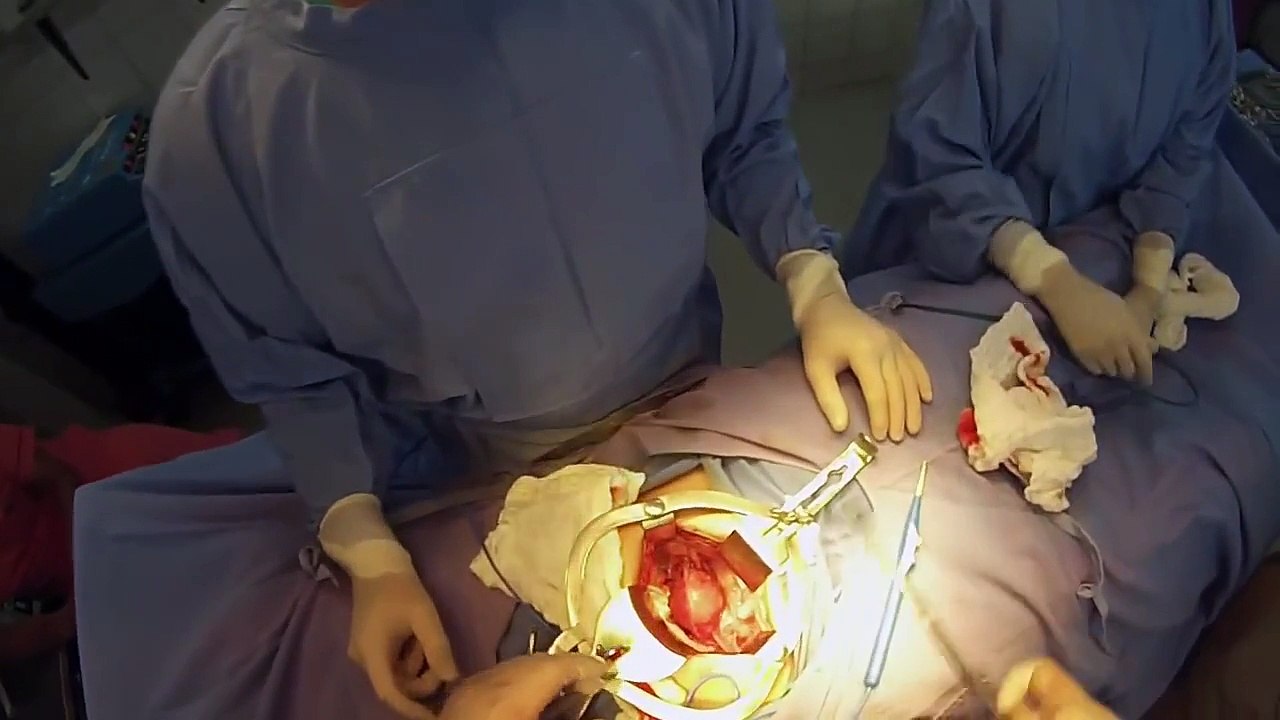 Histerectomía Abdominal Total