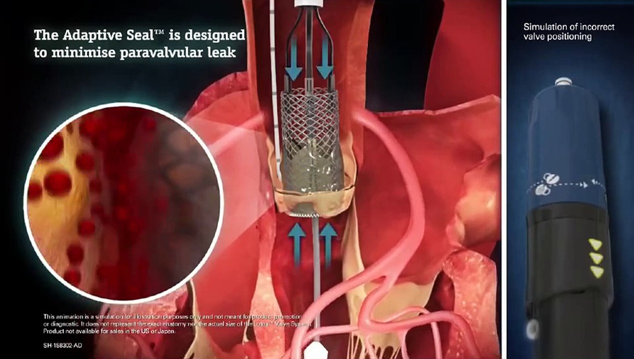 How the Lotus™ Valve System works