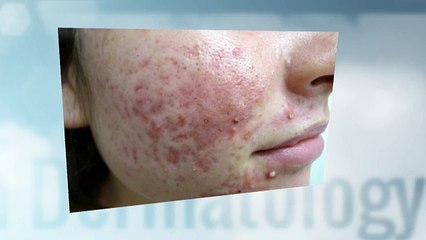 Top Ways To Treat Cystic Acne