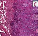 Histopathology Skin--Arsenical keratosis