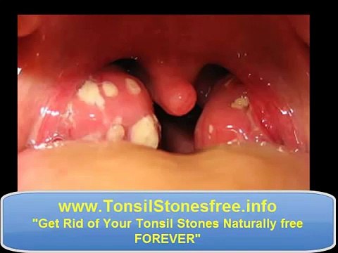 Waterpik tonsil stones ♣♣♣ How to remove Tonsil Stones ♣♣