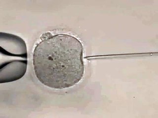 Injeção intracitoplasmática de espermatozóide (ICSI)