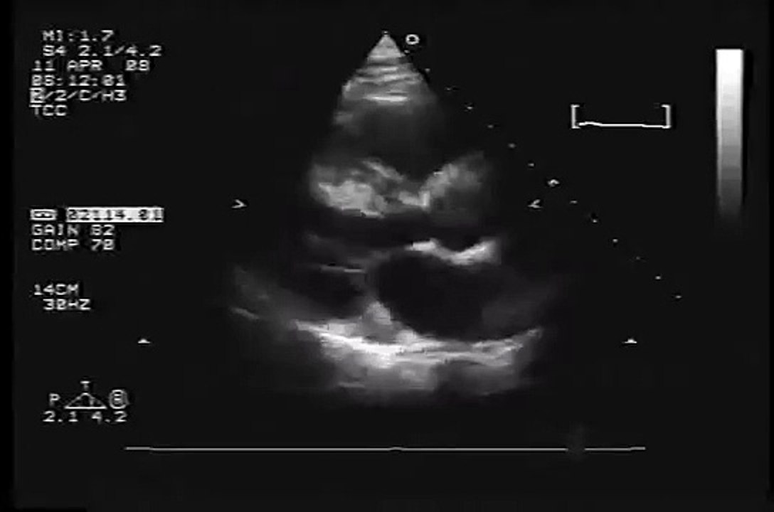Heart UltraSound Comparison - Hypertrophic Cardiomyopathy