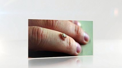 Top Ways To Remove Warts On Hands