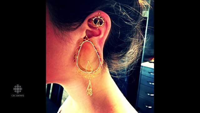 Chirurgie réparatrice pour les oreilles déformées par des piercings écarteurs