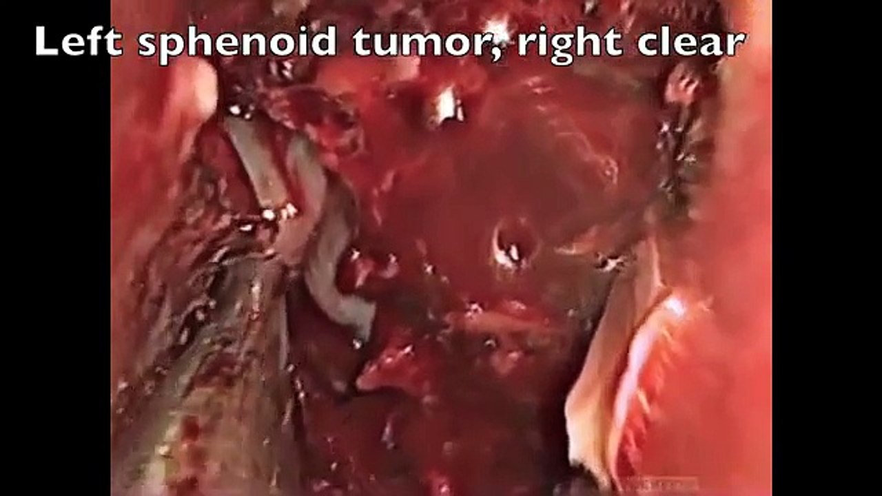 Exposed Carotid Artery during Pituitary Surgery