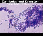 Zahnbelag und Zahnstein Medizin SelMcKenzie Selzer-McKenzie
