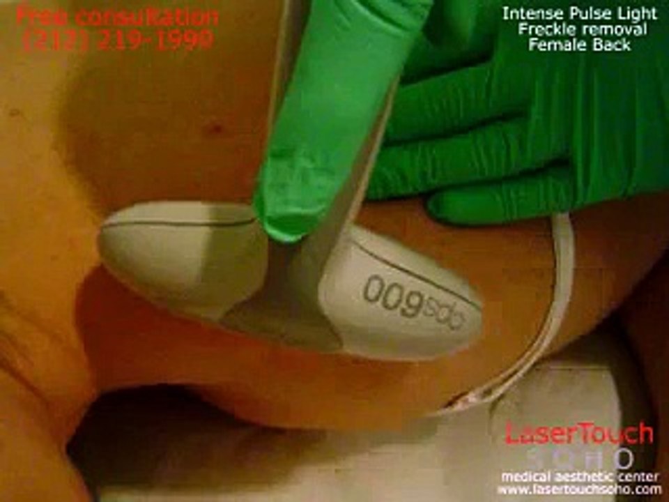 LaserTouch SoHo IPL  freckle removal.wmvNYC 212-219-1990
