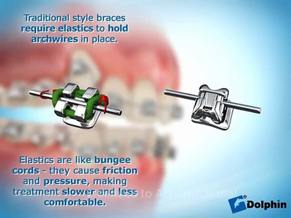 Damon System - Mountain View / Los Altos / Sunnyvale Orthodontist
