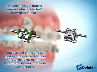 Damon System - Mountain View / Los Altos / Sunnyvale Orthodontist