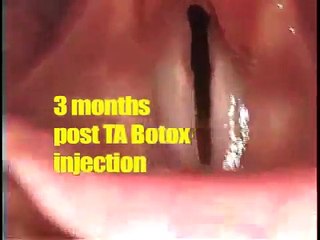Bilateral laryngeal paralysis