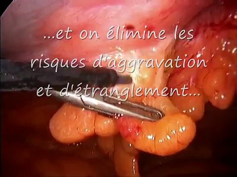 Hernie ombilicale coelio (Laparoscopic umbilical hernia repair)