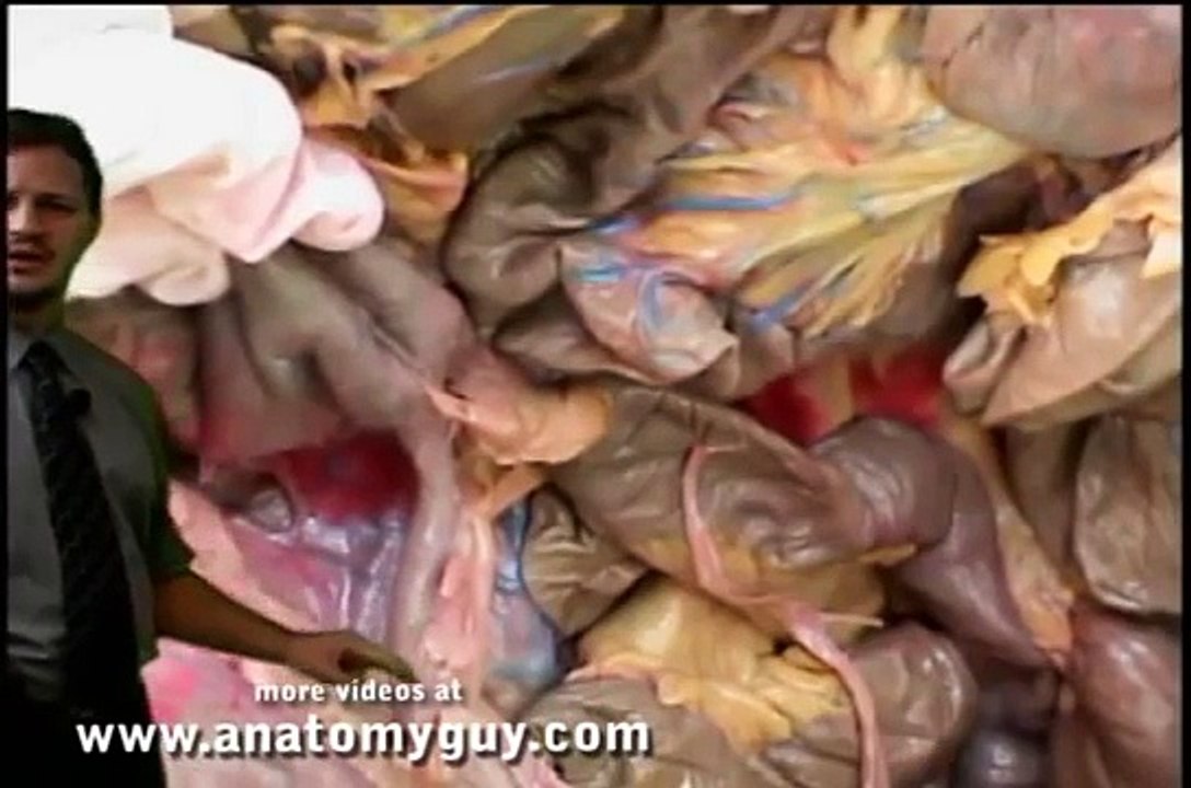 Laparoscopic Appendectomy General Surgery